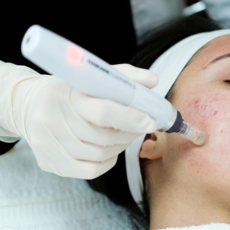 Laser Acne Treatment in Windham, NH