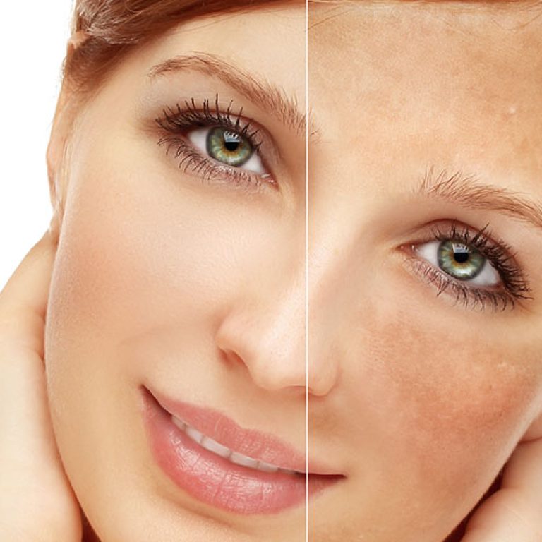 Lentigines (Brown Spots) Treatment