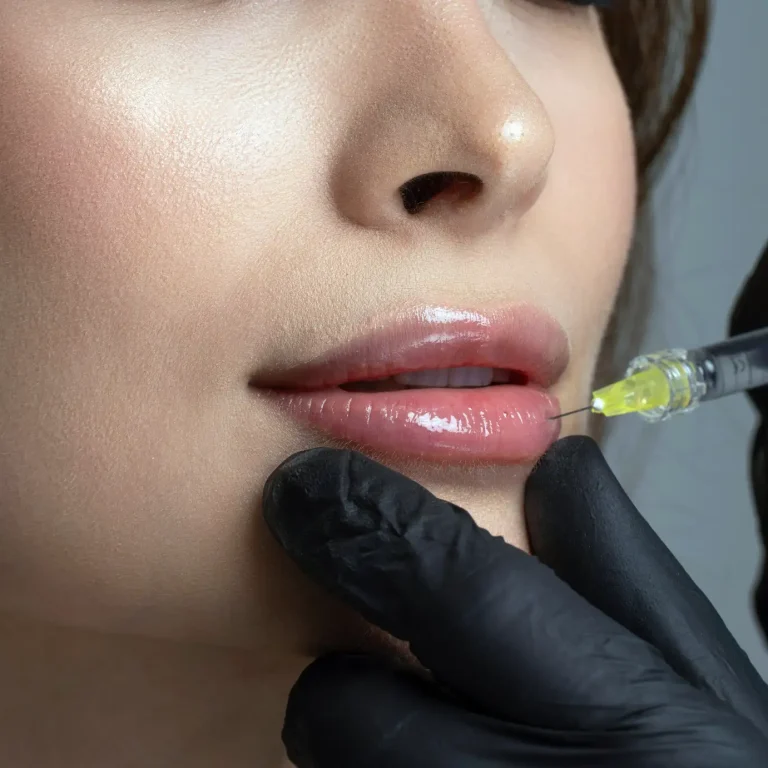 Lip Filler how long last