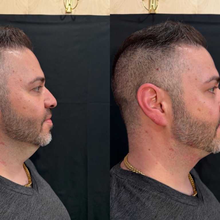 Dermal filler and PDO thread before after